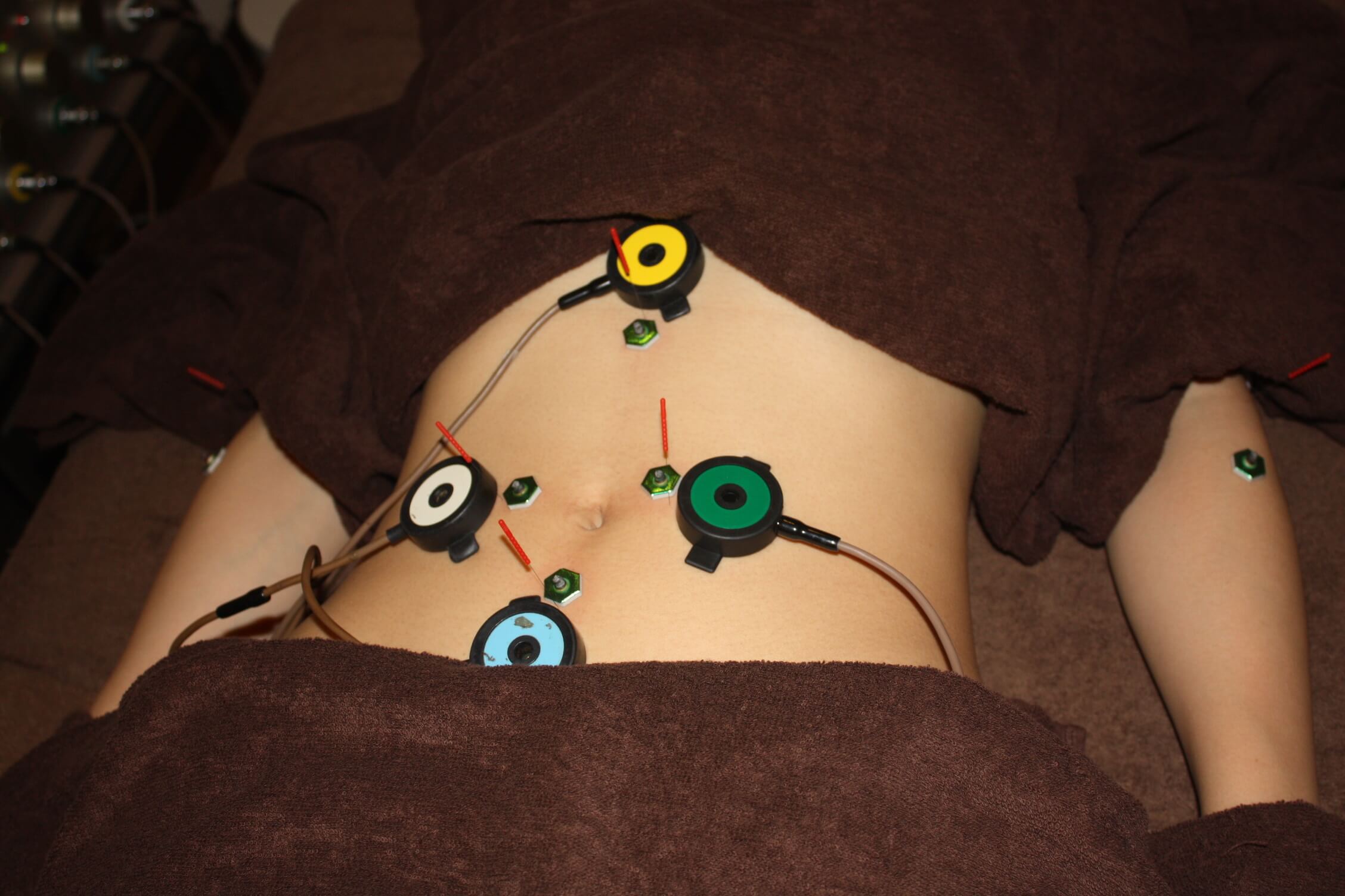 PMS(月経前症候群)のお腹への鍼灸治療
