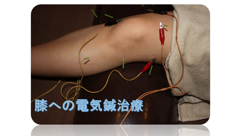 膝への電気鍼治療