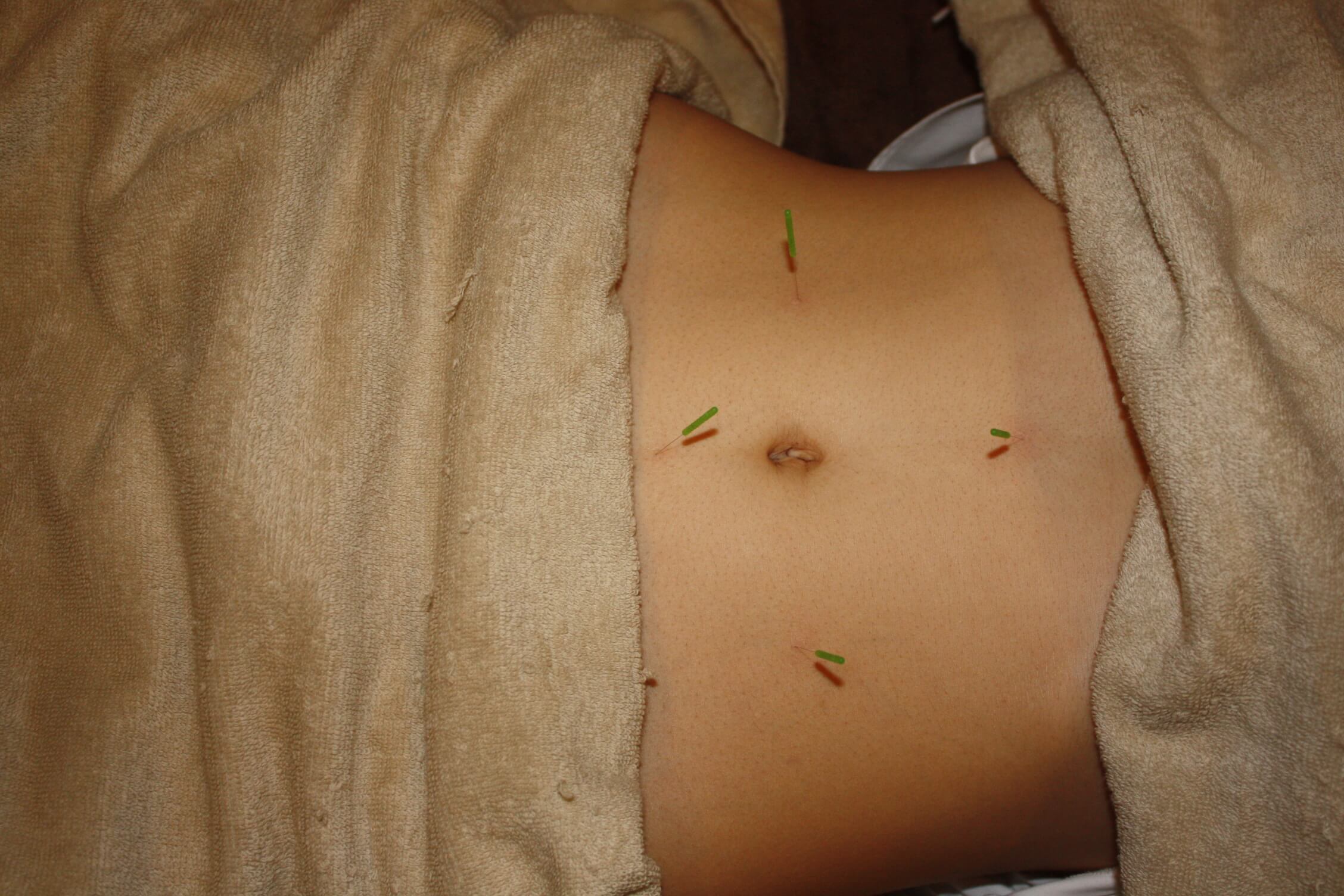 過敏性腸症候群の鍼治療