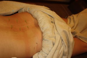 子宮内膜症に対する背部の鍼治療