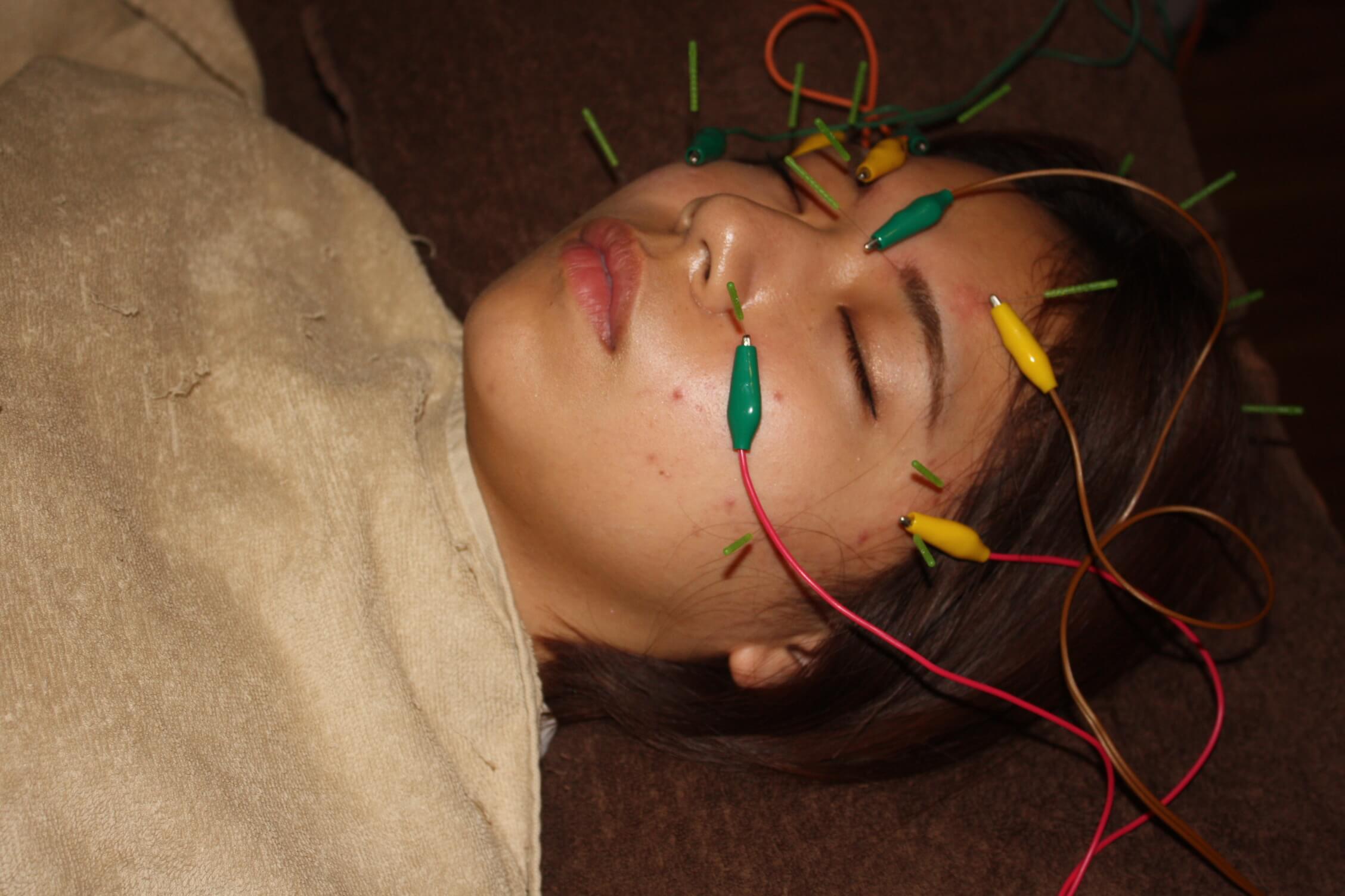 角膜炎・角膜潰瘍の鍼通電治療