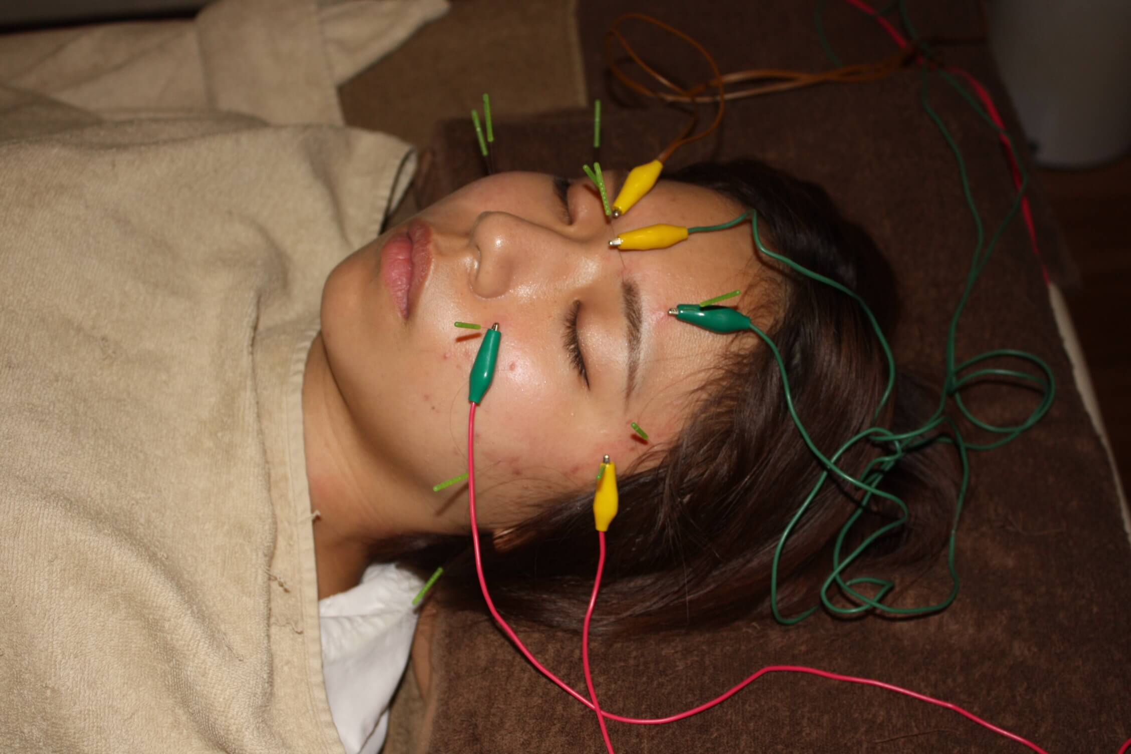 交感性眼炎の鍼灸治療