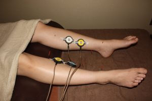 足底筋膜炎の下肢への鍼灸治療