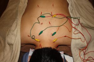 頸肩腕症候群の鍼通電治療