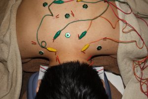 橈骨神経麻痺の頸部の鍼灸治療