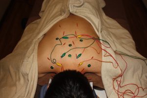 背中の痛みに対する鍼灸治療