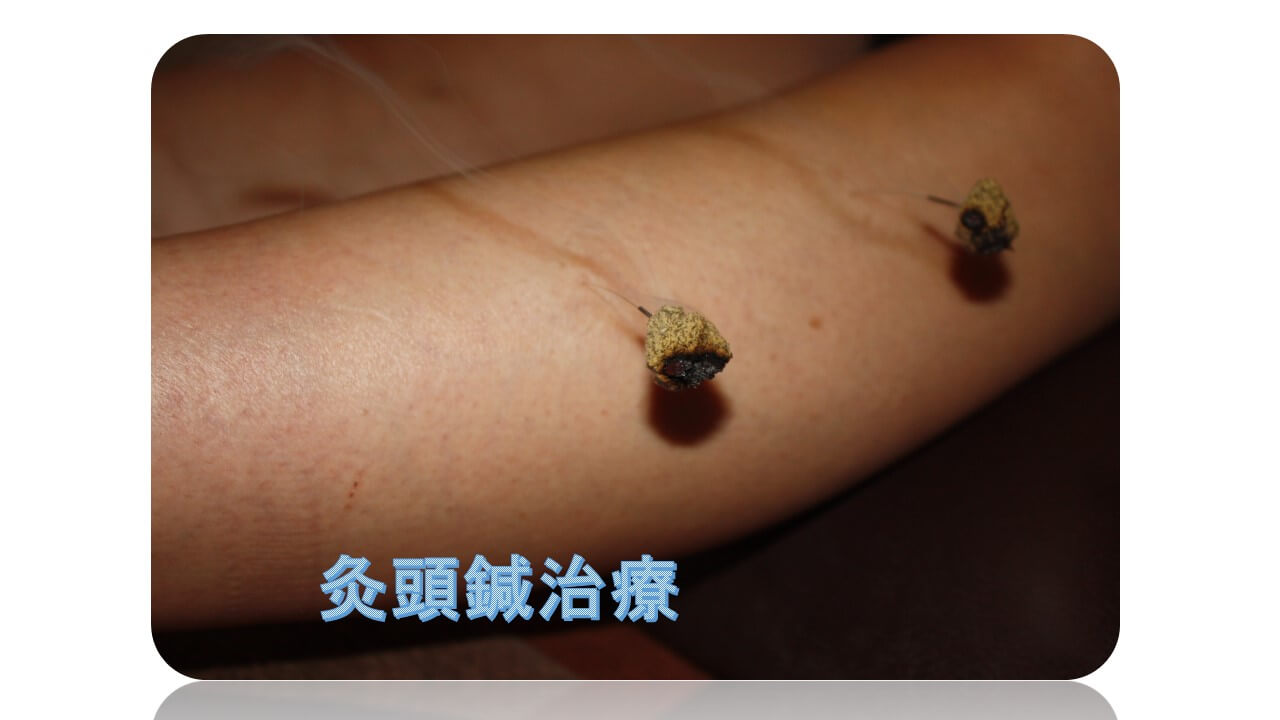 灸頭鍼