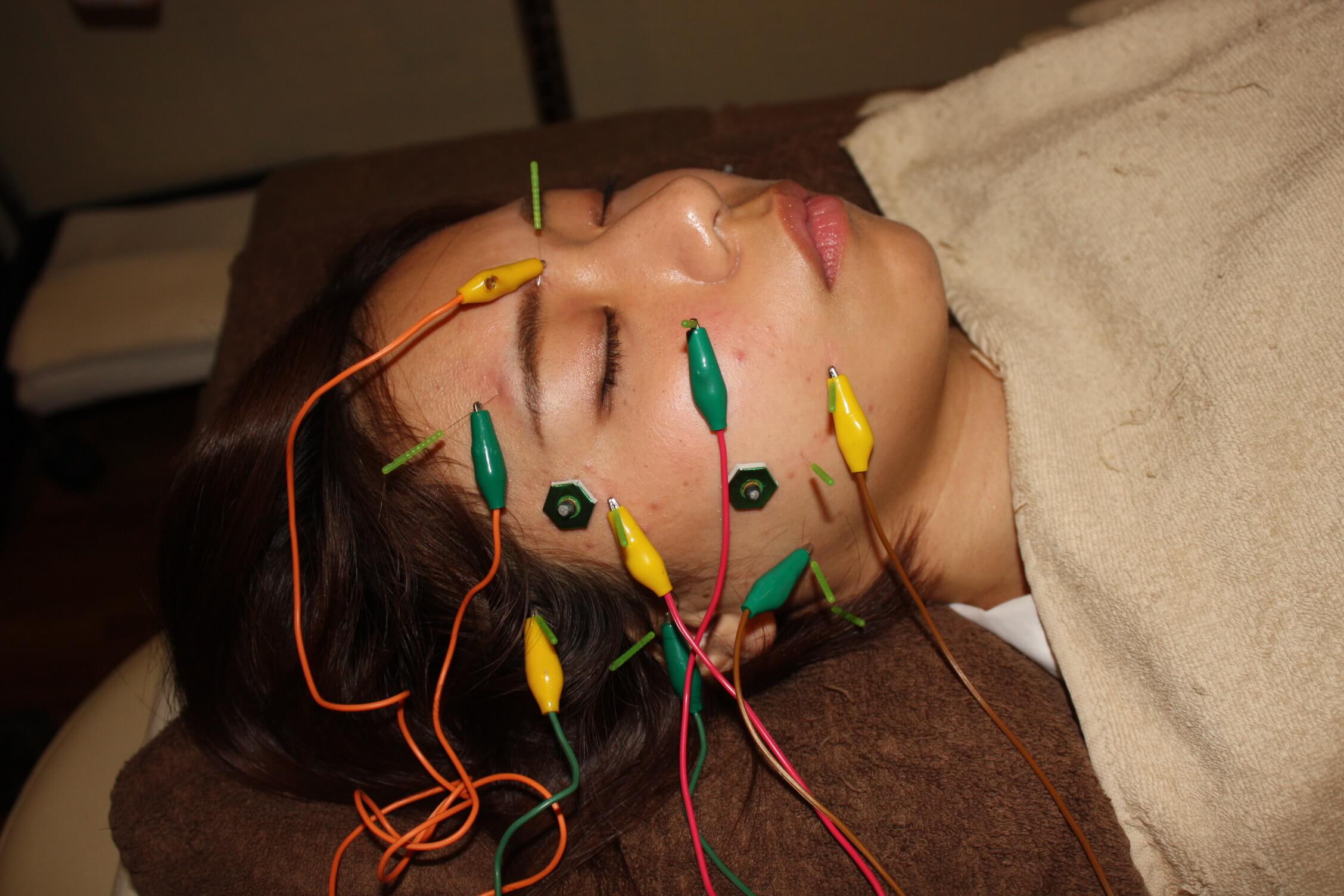 羞明感（結膜炎・ぶどう膜炎）の鍼通電治療