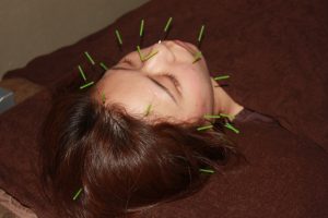 眼精疲労と頭痛症状に効果のある鍼灸治療