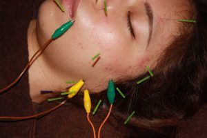 非定型顔面痛の鍼通電治療
