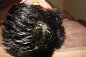 湿疹 頭皮 【医師監修】かゆみをともなう頭皮湿疹の原因とセルフケア・皮膚科での治療
