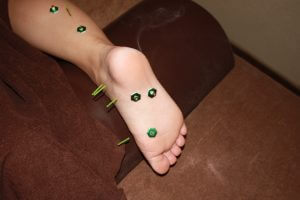 足底筋膜炎の鍼灸治療