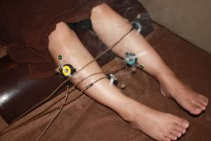 タナ障害の下肢への鍼灸治療