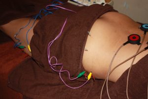 変形性股関節症の腰部・臀部への鍼灸治療