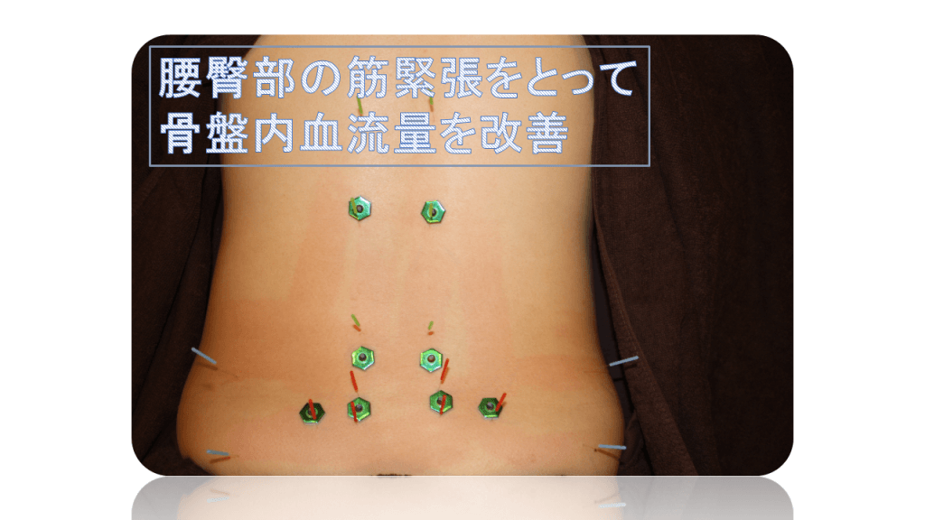 おりもの異常に対する鍼灸治療