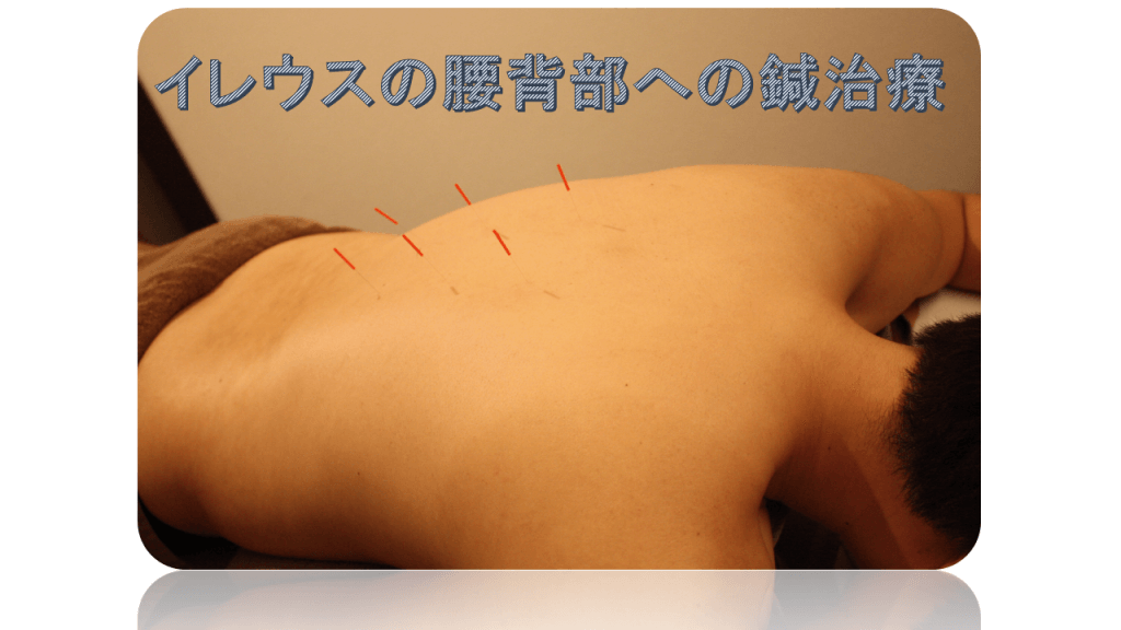 イレウスの腰背部への鍼治療