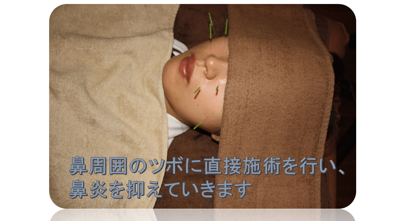 寒暖差アレルギー鼻炎鍼治療