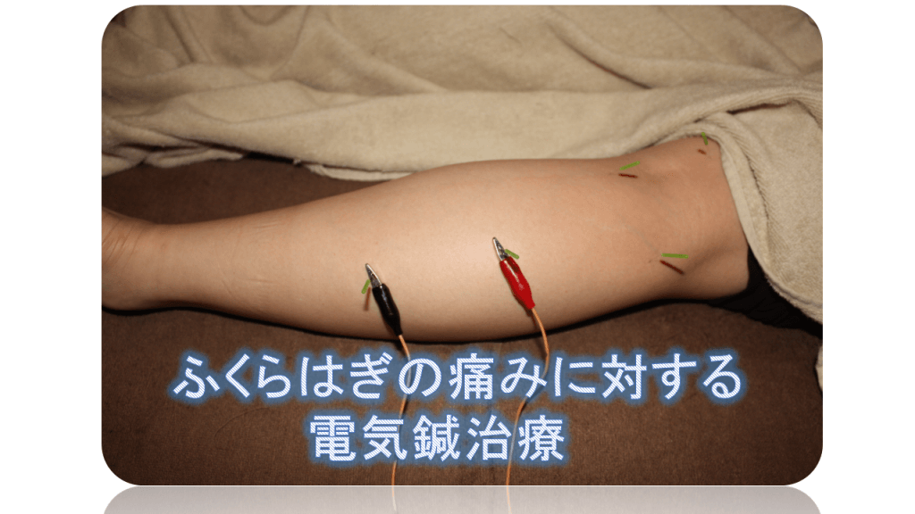 ふくらはぎの痛みに対する電気鍼治療