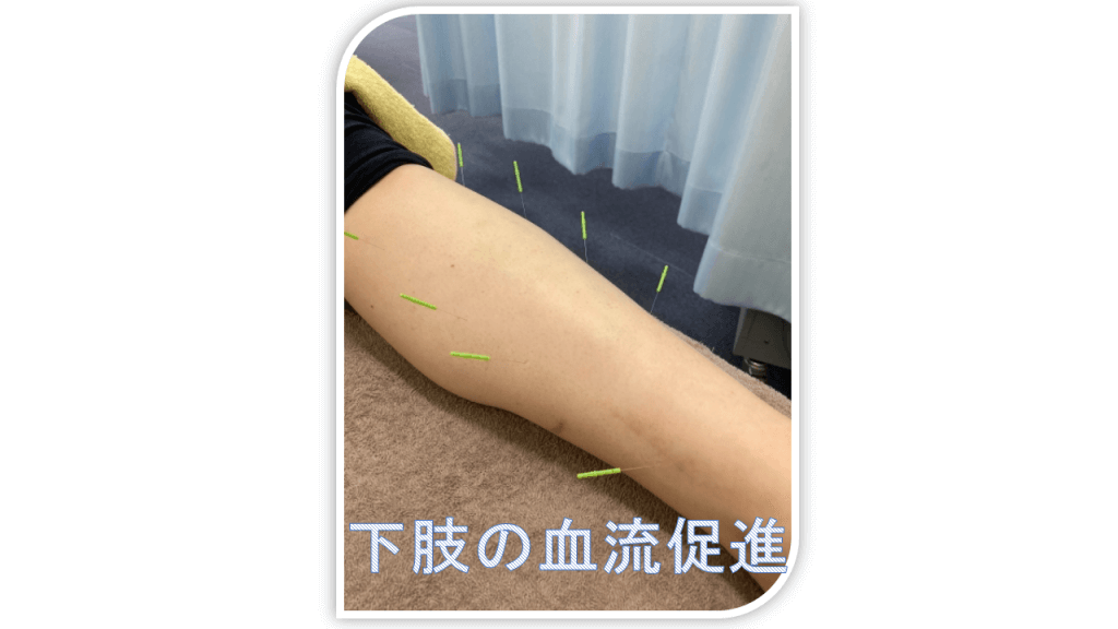 下肢の血流促進鍼灸