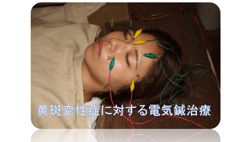 黄斑変性症に対する電気鍼治療2